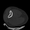 SPORK, NICO - 22.03.1976 - 02.08.2022 - CT obere Extremität - 17:51:17
